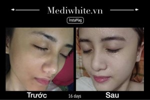 Trước và sau khi sử dụng quy trình dưỡng trắng da với MediWhite