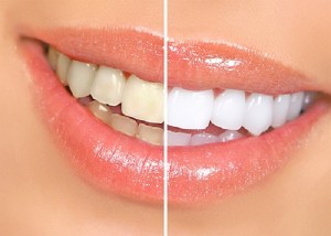 Trước và sau khi tẩy răng