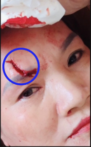 Vết thương trên mặt bà Phạm Bích Ngọc