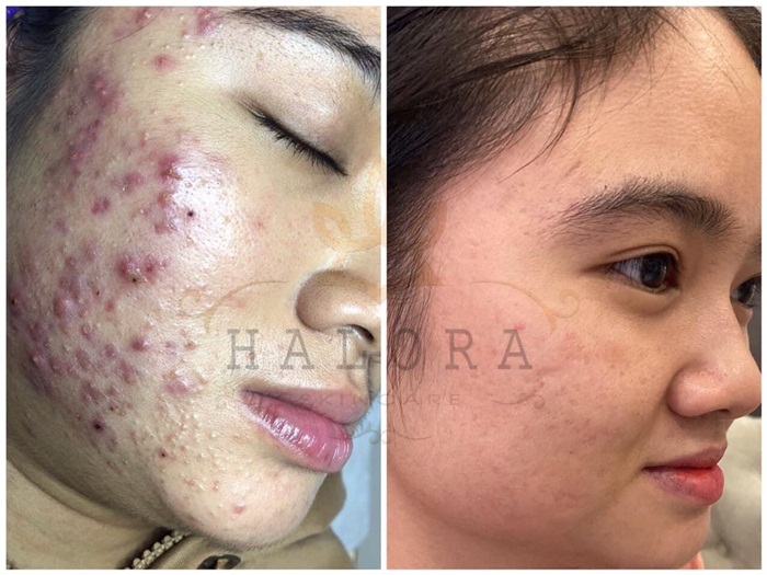 Trước và sau khi điều trị mụn tại Vân Nguyễn Spa