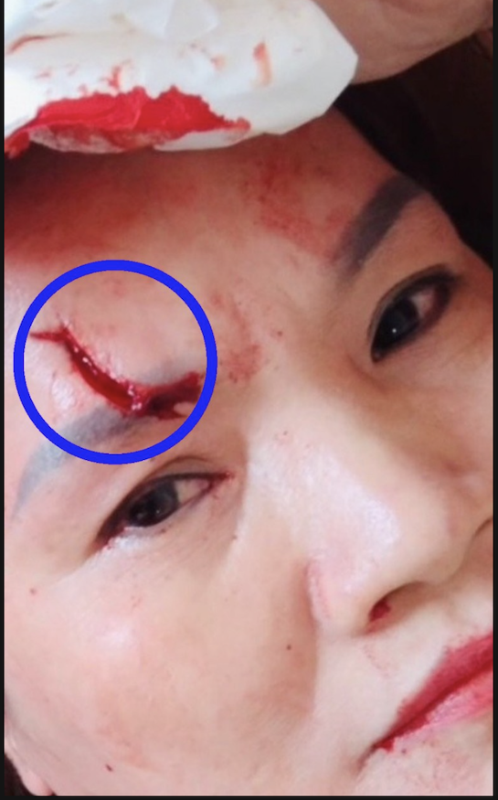 Vết thương trên mặt bà Phạm Bích Ngọc